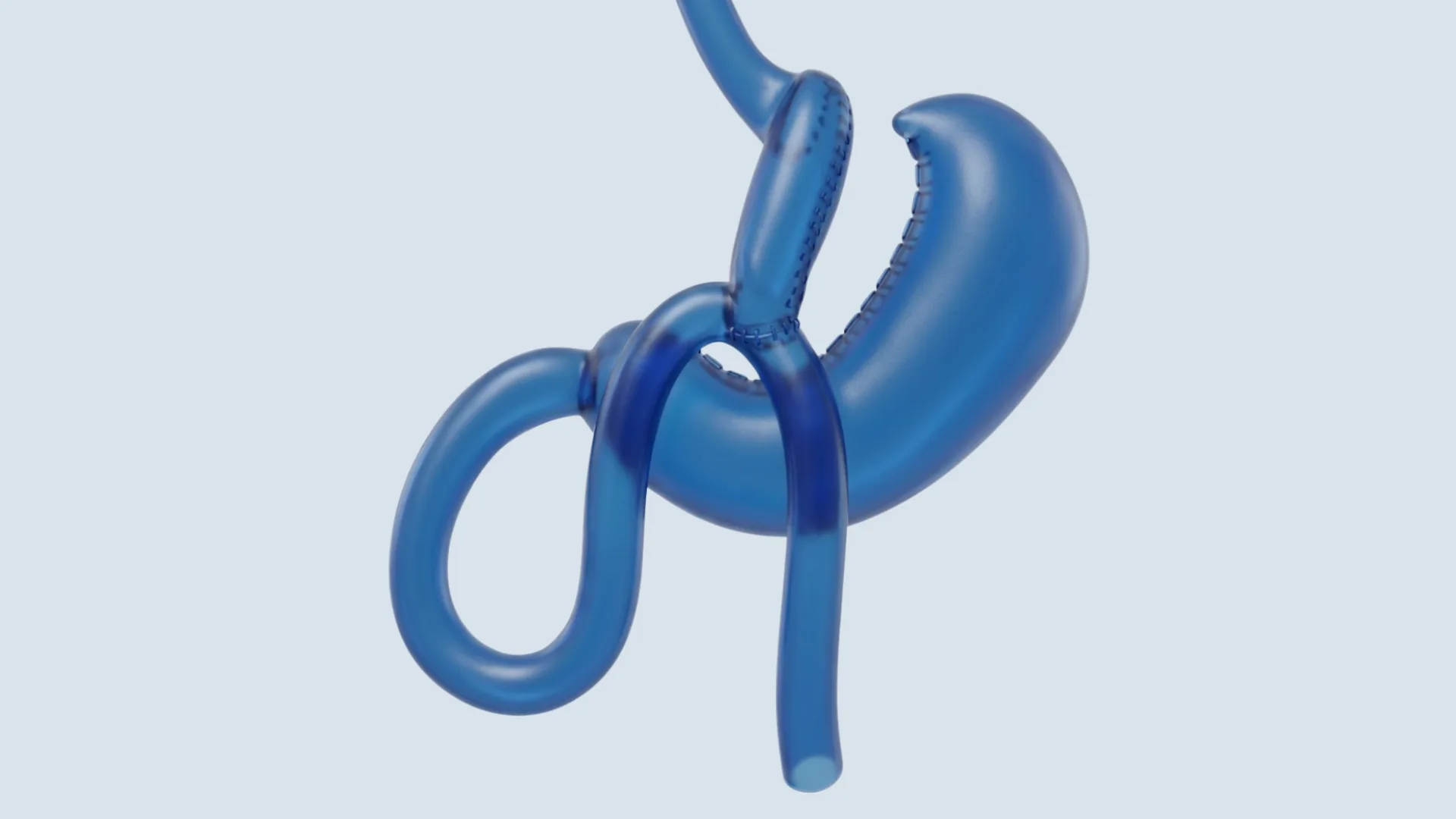 Illustration of a mini gastric bypass showing the stomach pouch and the bypassed section of intestine