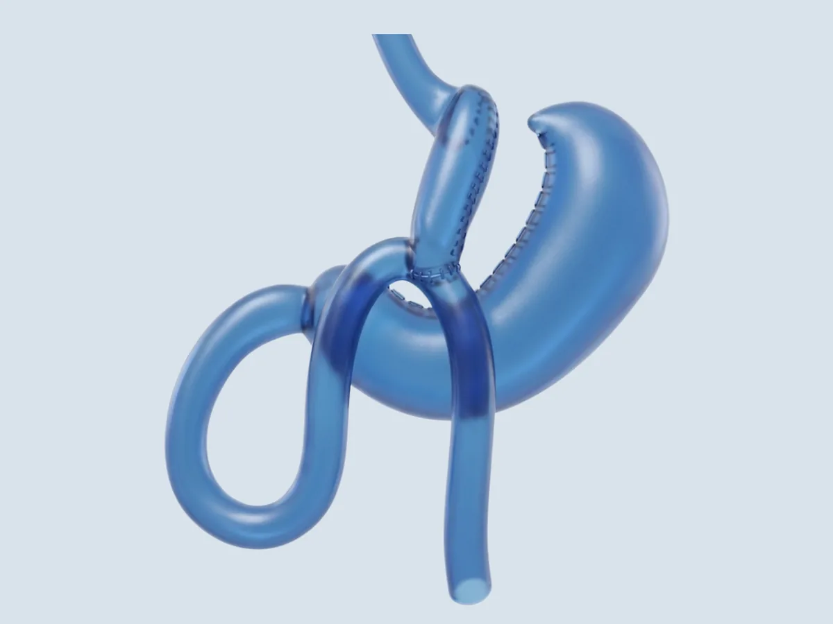 Mini Gastric Bypass (One-Anastomosis) procedure illustration