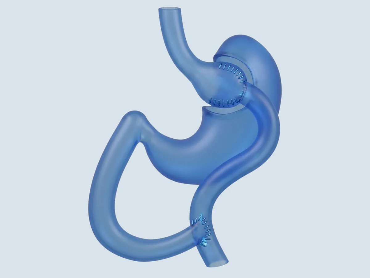 Roux-en-Y Gastric Bypass procedure illustration